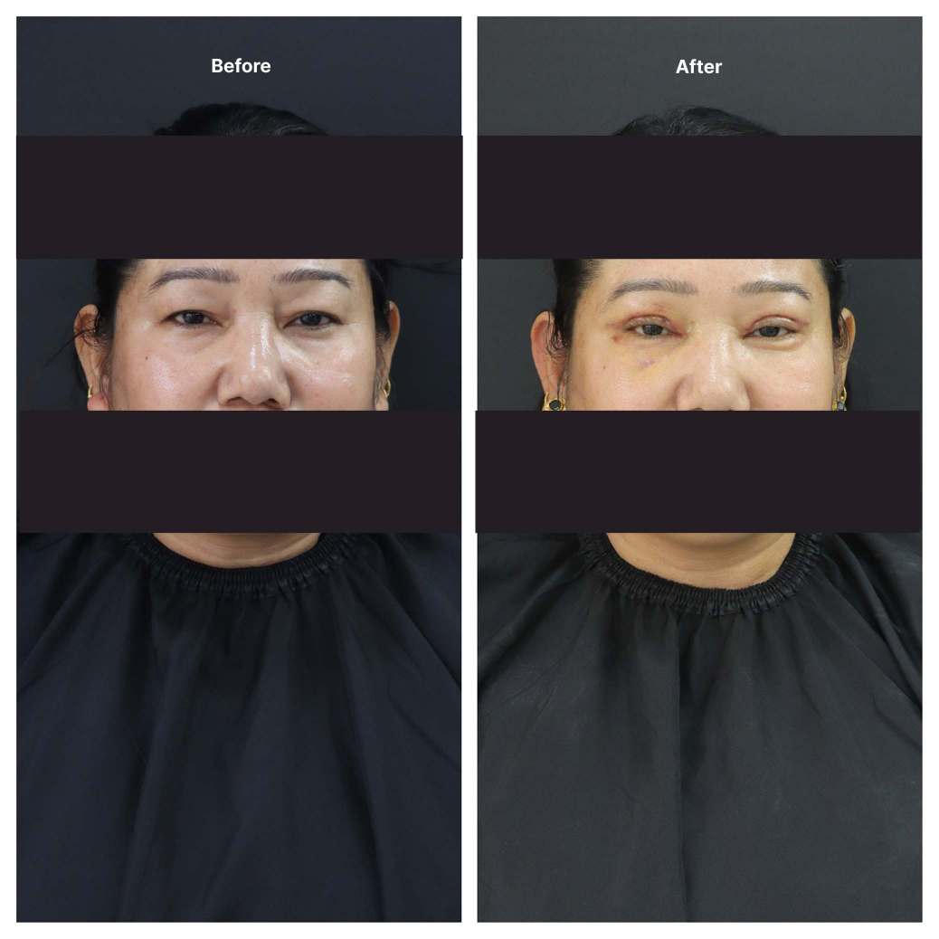 Eyelid Surgery KOQ10